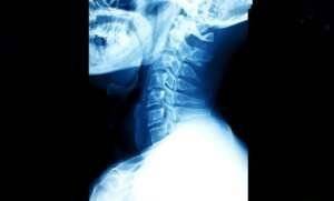 Cervical Radiculopathy