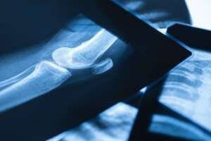 Post Surgical Bone Healing