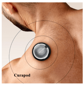 cervical radiculopathy causes curapod