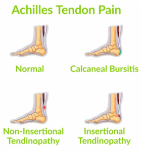 Managing and Treating Achilles Tendon Pain