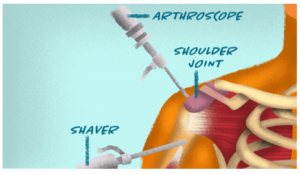 frozen shoulder surgery